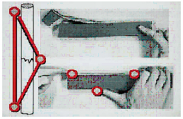 Схема функционирования повязки по A. Sarmiento: гидростатическое напряжение при мышечных сокращениях находит опору во внешней повязке и способствует повышению стабильности перелома