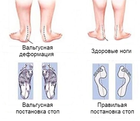 Как выглядит вальгусная деформация в сравнении со здоровыми ногами